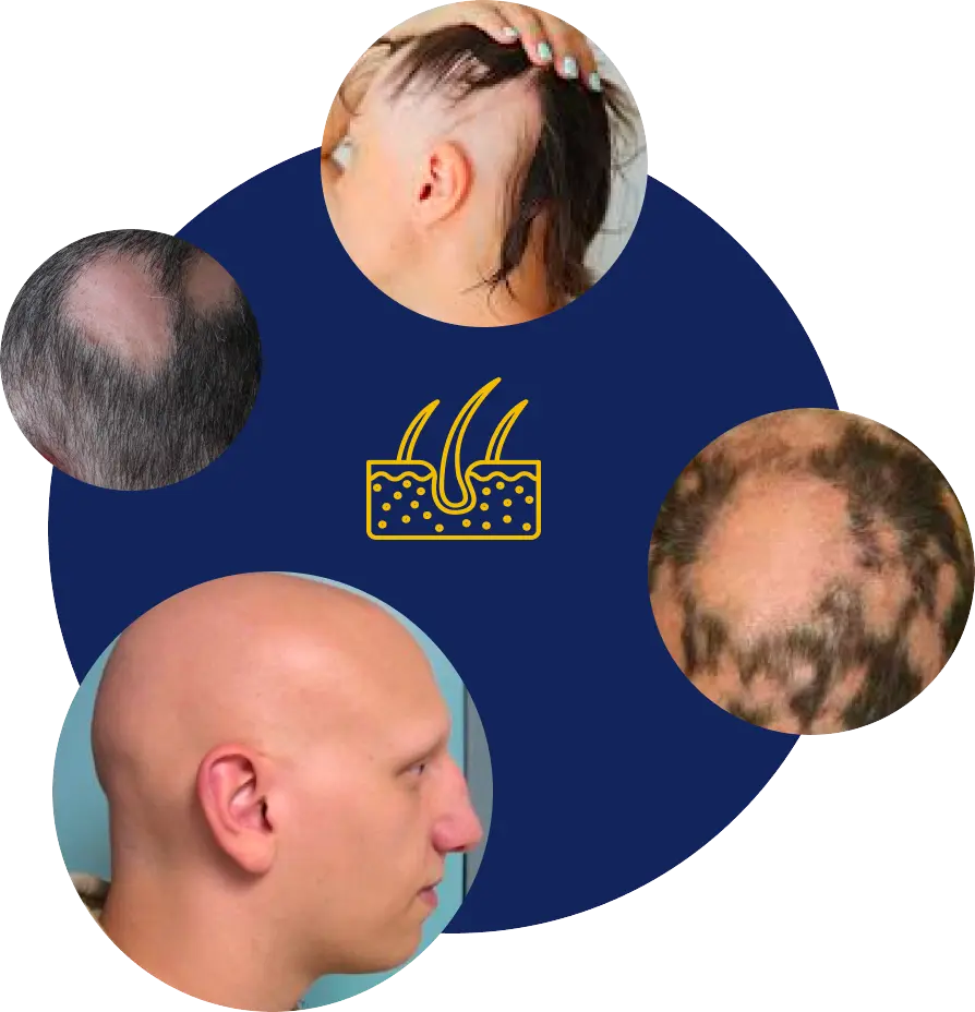Alopecia Areata - National Alopecia Areata Foundation | NAAF