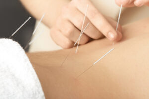 Some people try acupuncture as a treatment for alopecia areata.