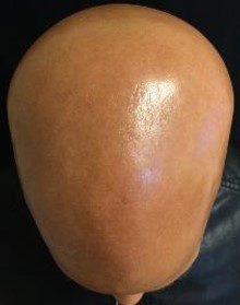 Scalp with alopecia areata universalis