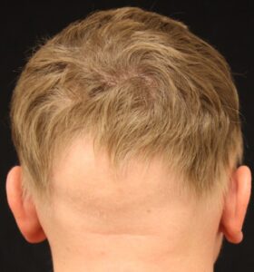 Ophiasis alopecia areata