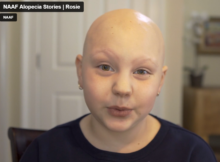 Girl discussing living with alopecia areata, in a webinar