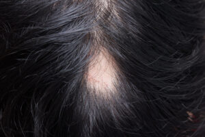Alopecia Areata symptoms - Spot Baldness