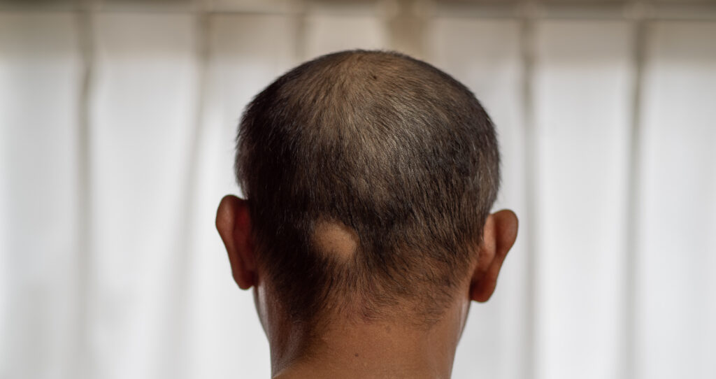 Patchy hair loss is one alopecia areata type