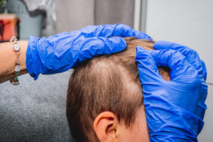 Man receiving topical treatment for alopecia areata