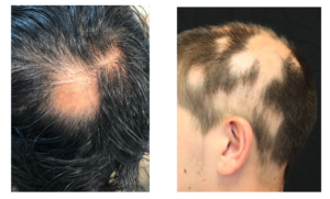 Alopecia Areata Types - National Alopecia Areata Foundation | NAAF