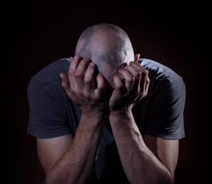 Black man with alopecia areata has his head in his hands, feeling of depression