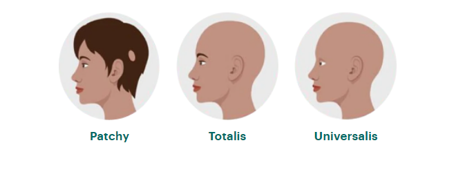 different types of AA and AA prevalence